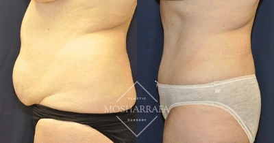 Before and after tummy tuck displaying lateral abdominal contour