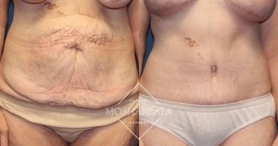Before and after tummy tuck showing reduced abdominal skin excess and improved contour