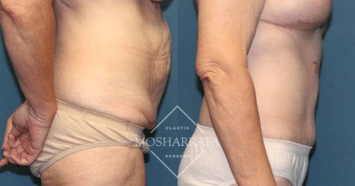 Before and after tummy tuck from side angle displaying smoother abdominal profile