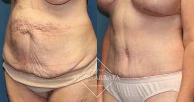 Before and after tummy tuck front view showing tightened abdominal skin and improved definition