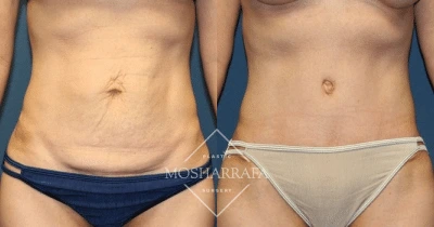 Before and after tummy tuck displaying reduced skin laxity and enhanced abdominal contour