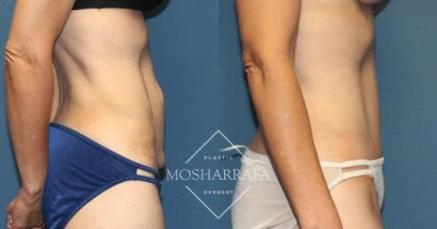 Before and after tummy tuck results showing frontal torso view with improved abdominal contour