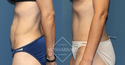 Before and after tummy tuck results showing side profile view with flattened abdomen