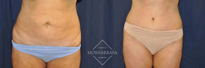 Before and after tummy tuck front view showing abdominal flatness and waist definition