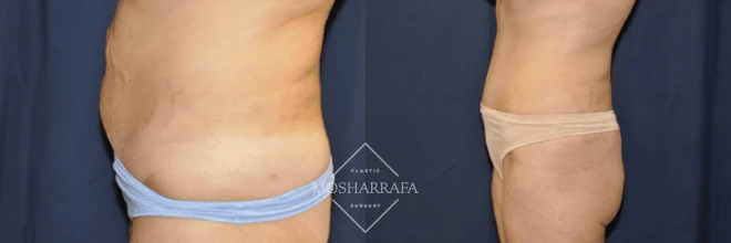 Before and after tummy tuck side view showing torso contouring results