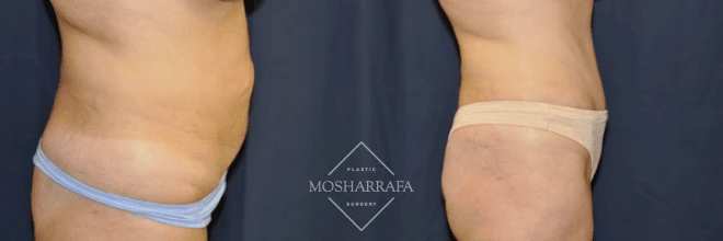 Before and after tummy tuck side view showing abdominal and flank improvement