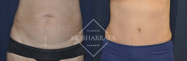 Before and after tummy tuck, front view of abdominal tightening results