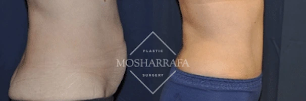 Before and after tummy tuck showing abdominal contouring results