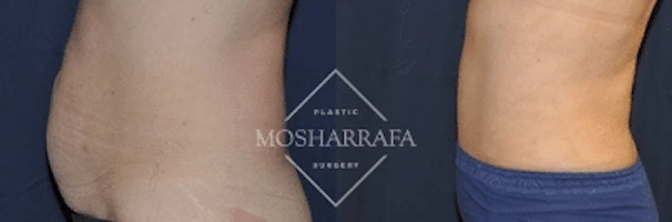 Before and after tummy tuck displaying improved abdominal profile