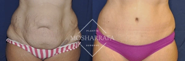 Before and after tummy tuck with frontal abdominal results