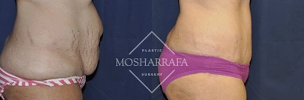 Before and after tummy tuck showing reduced abdominal skin laxity and improved waistline definition