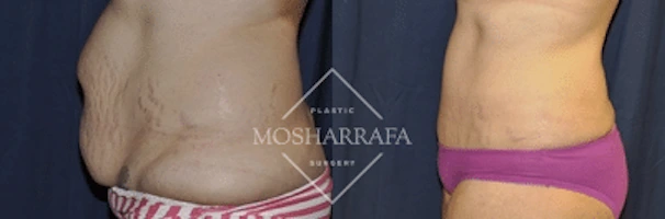 Before and after tummy tuck demonstrating flattened abdomen and tighter midsection