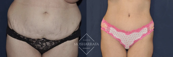 Tummy tuck before and after, frontal view showing significantly reduced skin laxity and contoured abdomen
