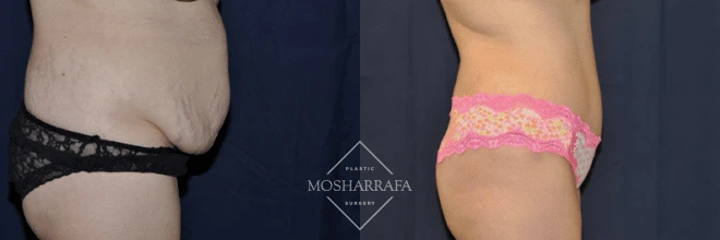 Tummy tuck before and after, side view showing tightened abdominal skin and improved body contour