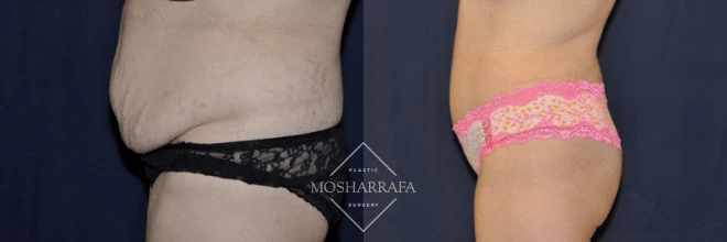 Tummy tuck before and after, side view demonstrating flattened abdomen and enhanced waistline definition