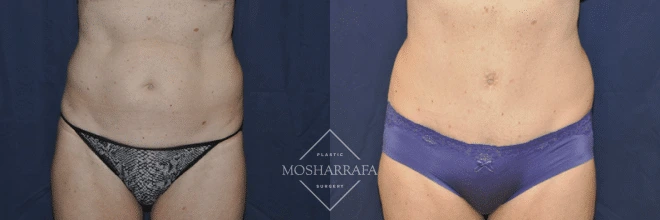 Before and after abdomen and waist tummy tuck results