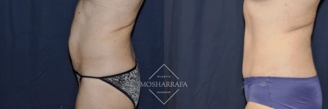 Before and after abdominal contouring, frontal and side view