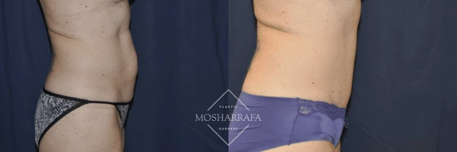 Before and after abdominal contouring, frontal and side view