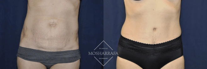 Before and after tummy tuck: front view showing elimination of excess abdominal skin and muscle tightening