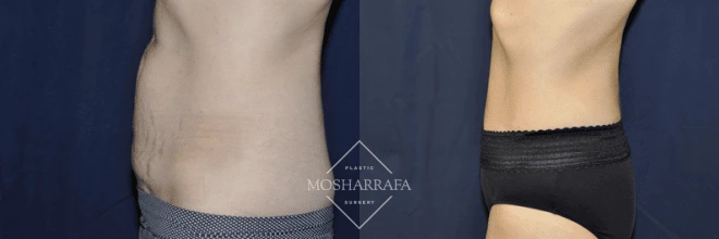 Before and after abdominal contouring, frontal and side view