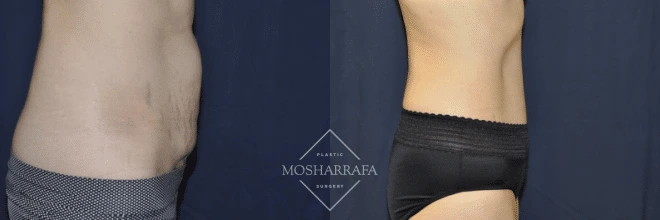 Before and after abdominal contouring, frontal and side view