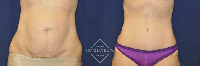 Before and after tummy tuck case 204, front view showing abdominoplasty results