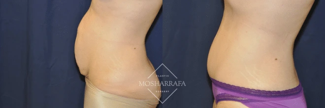 Before and after tummy tuck, side view showing abdominal contour improvement