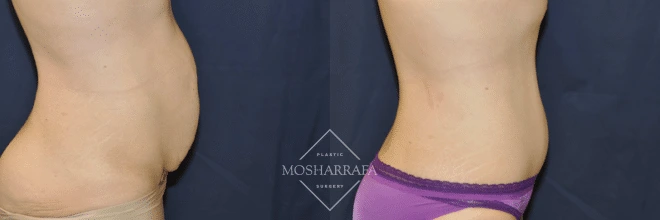 Before and after tummy tuck, side profile comparison of abdominal appearance
