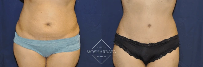 Before and after abdominal contouring, frontal view