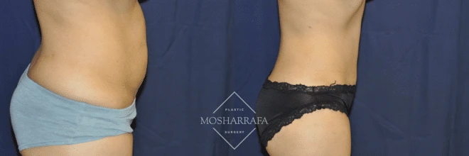 Tummy tuck before and after, patient torso showing reduced abdominal laxity and improved contour