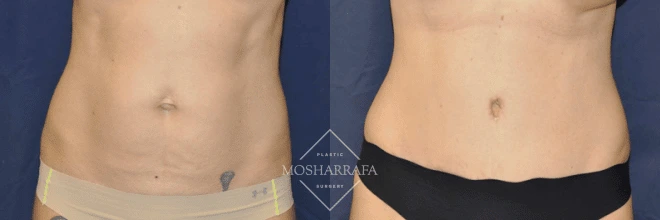 Before and after tummy tuck results showing frontal torso view with enhanced abdominal tone