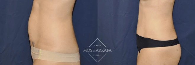 Before and after tummy tuck: front view showing reduced abdominal skin laxity and improved contour