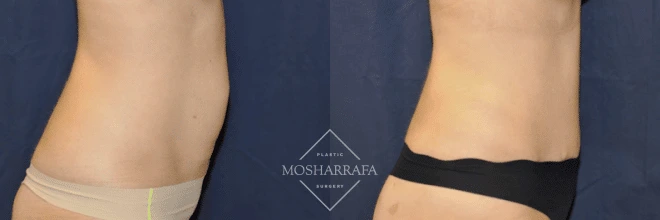 Before and after tummy tuck: side profile showing flattened abdomen and improved waistline definition