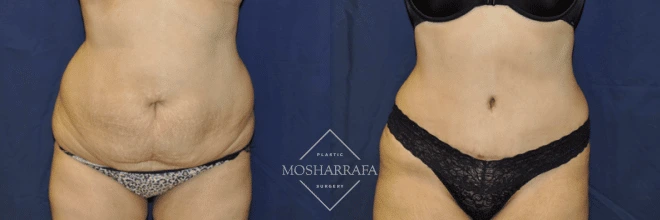 Before and after tummy tuck: front view showing removed excess skin and tightened abdominal muscles