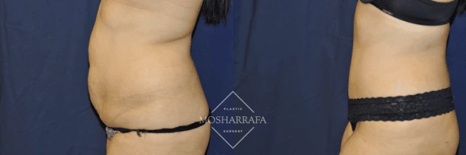 Before and after tummy tuck: side profile showing reduced lower abdominal fullness and improved body contour