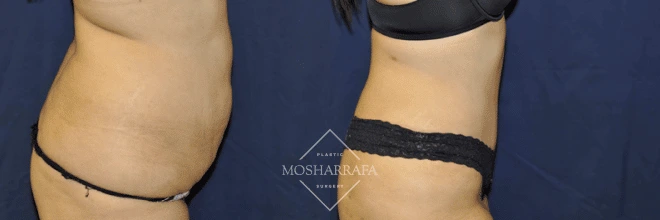 Before and after tummy tuck: side profile demonstrating abdominal skin tightening and enhanced silhouette