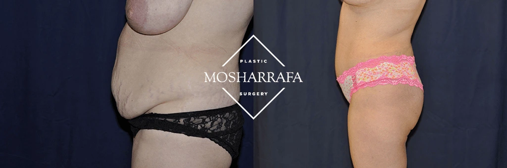 Before and after tummy tuck surgery showing front and side views with reduced abdominal contour