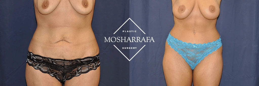 Before and after tummy tuck front view showing tightened abdomen and improved body contours