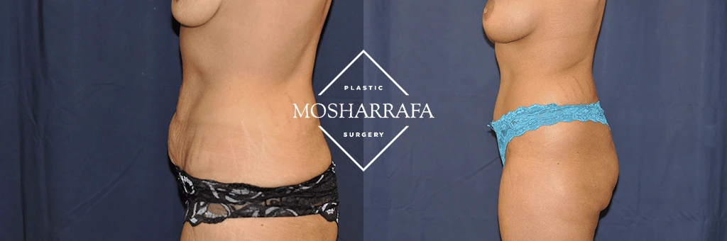 Before and after tummy tuck results showing side view of abdomen with improved contour