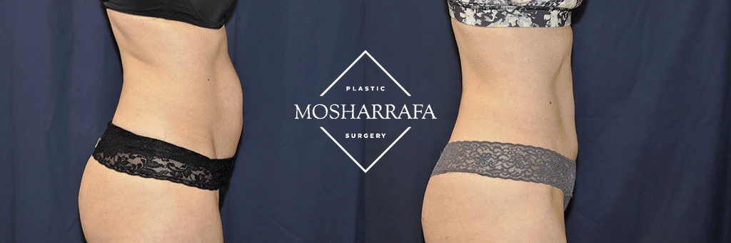 Before and after tummy tuck results showing side view of torso with enhanced abdominal definition