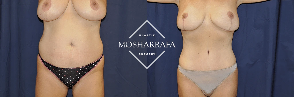 Before and after tummy tuck results showing front view of torso and chest area