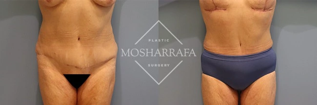 Before and after tummy tuck, front view demonstrating abdominal definition and tightening