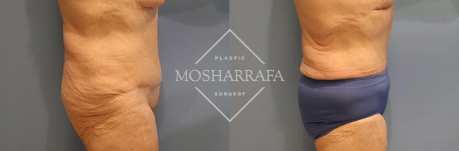 Before and after tummy tuck, side view showing improved abdominal skin elasticity