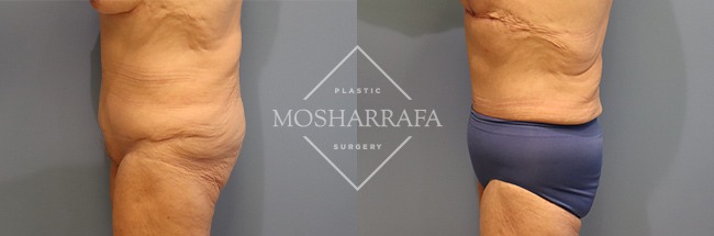 Before and after tummy tuck, oblique view showing abdominal contour improvement