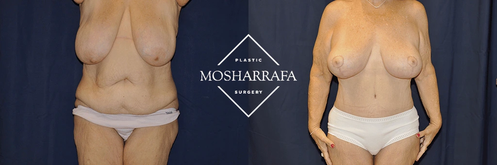Before and after tummy tuck: front view showing reduced excess skin and improved abdominal definition