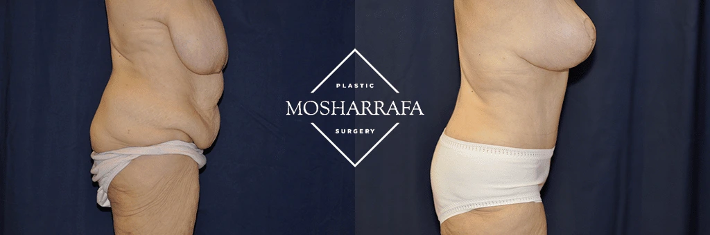 Before and after tummy tuck: side view displaying flattened midsection and refined body contour