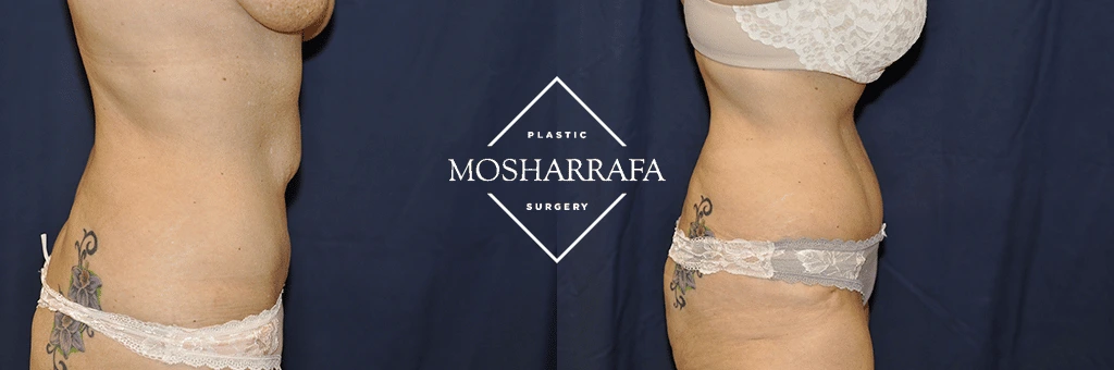 Before and after tummy tuck, frontal view showing reduced abdominal fullness and improved contour