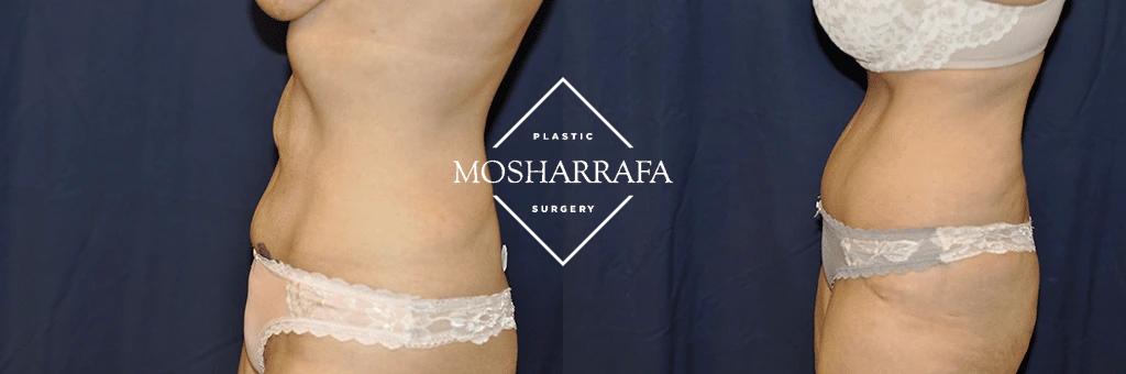 Before and after tummy tuck, side view showing flatter abdomen and defined waistline