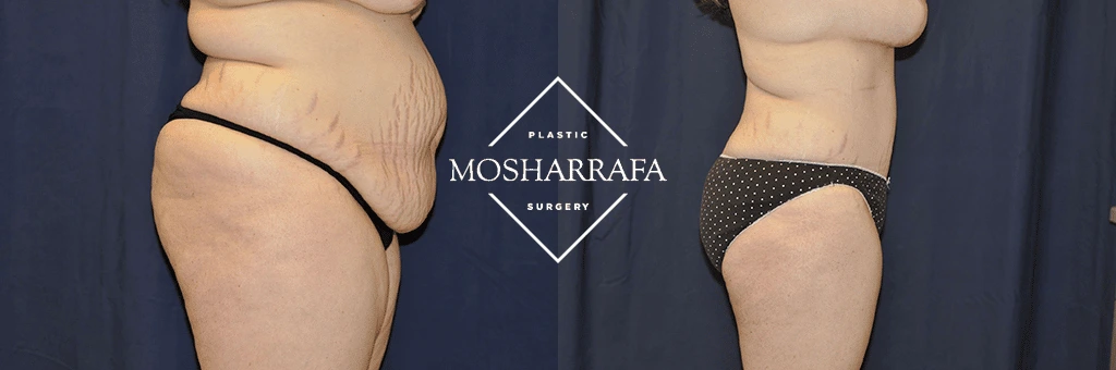 Before and after tummy tuck, side view showing eliminated abdominal laxity and improved profile