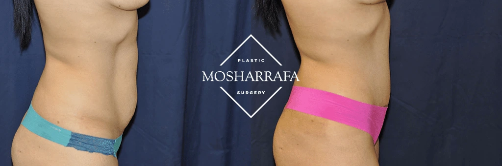tummy-tuck-case-302-2